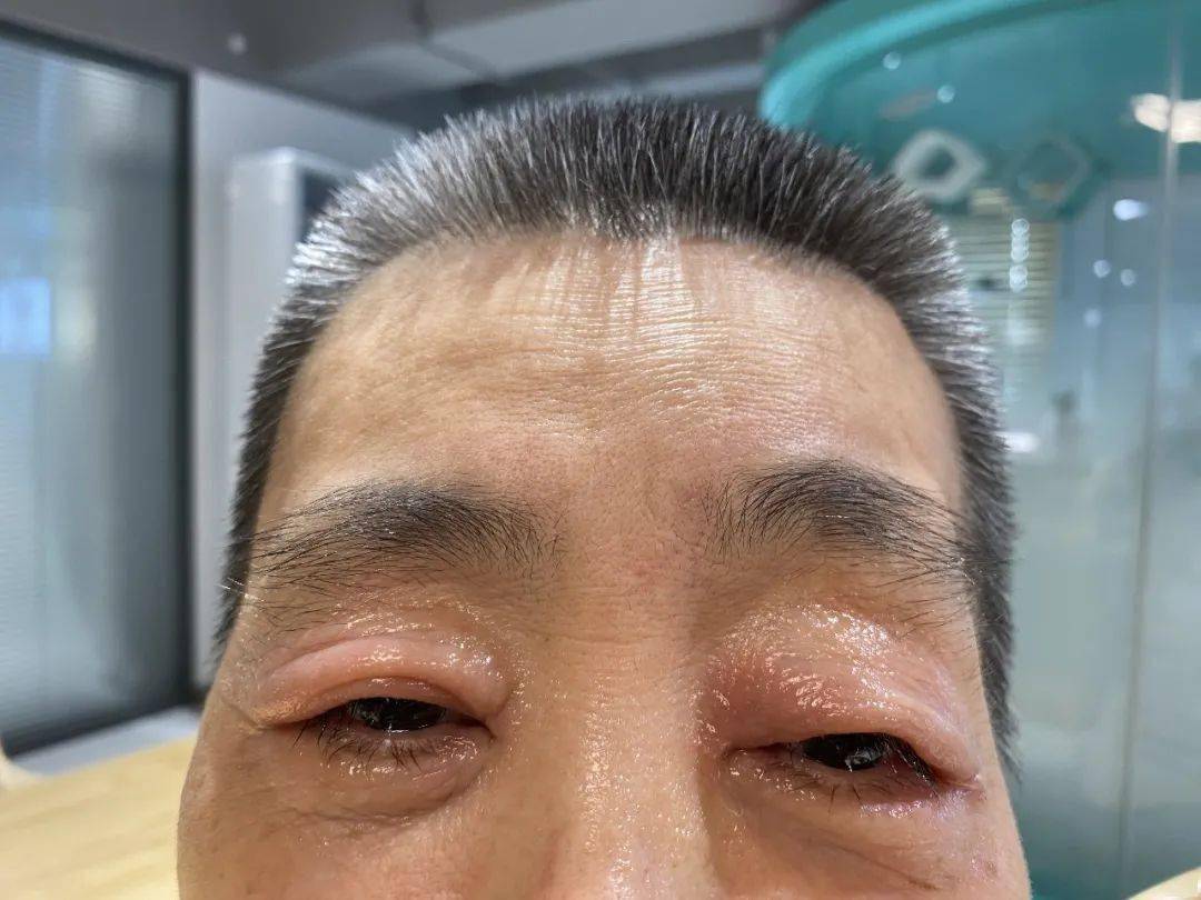 过敏性结膜炎( allergic conjunctivitis),即过敏导致的结膜炎.