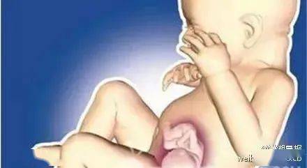 九江|罕见！九江刚满月的男婴竟“怀”了宝宝？“剖宫产”取出一四肢健全胎儿