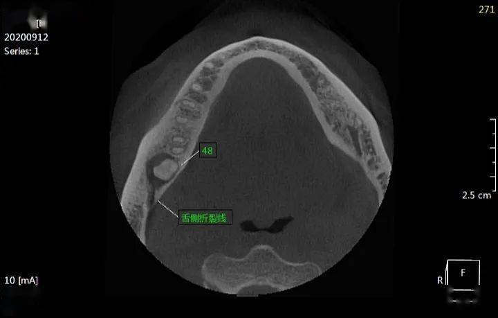 可见低密度阴影,阴影和根尖对应神经管融合,远中舌侧可见牙槽骨骨折线