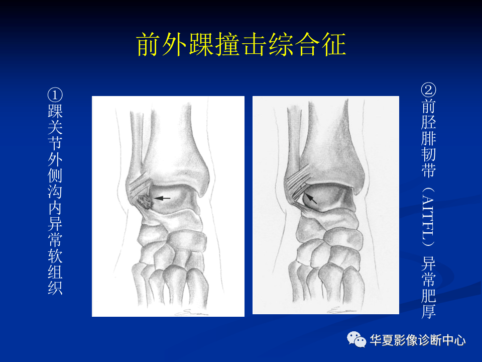 踝关节撞击综合征 来自搜狐网