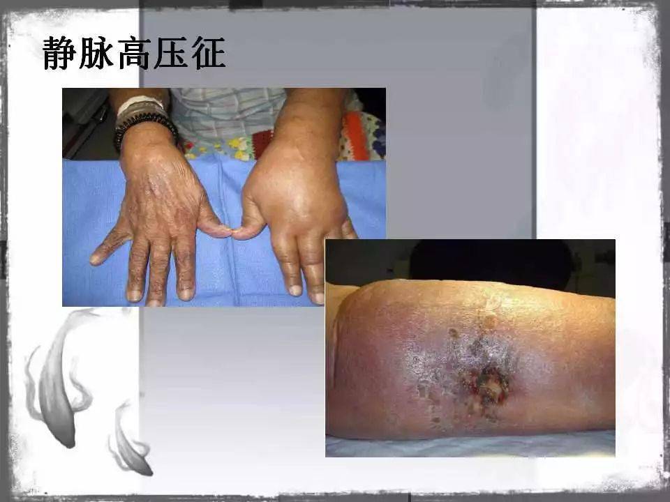 自体|血管通路 | 自体动静脉内瘘成形术