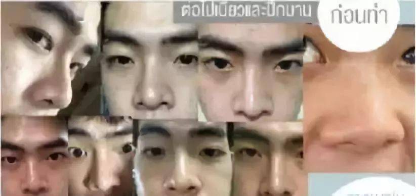 生活|泰国小哥花15万整形，成功从屌丝逆袭变男神！