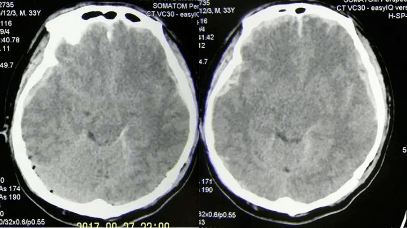 ct示双侧额颞部硬膜下血肿,弥漫性脑肿胀,蛛网膜下腔出血,多发头皮