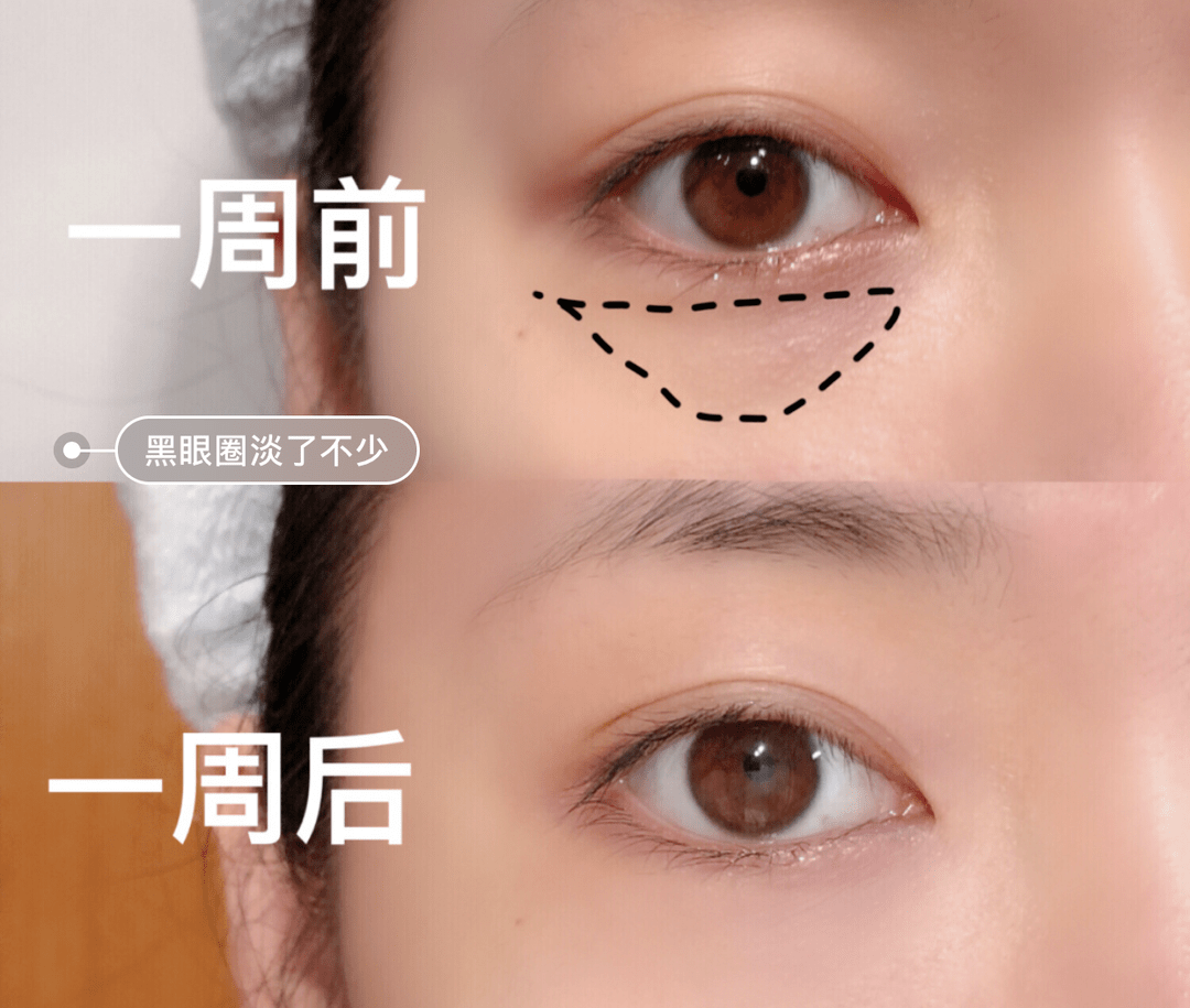 贫民窟|杨幂熬夜后护肤要花2万块？怪不得皮肤吹弹可破！贫民窟女孩就不配消除熬夜痘、黑眼圈吗？