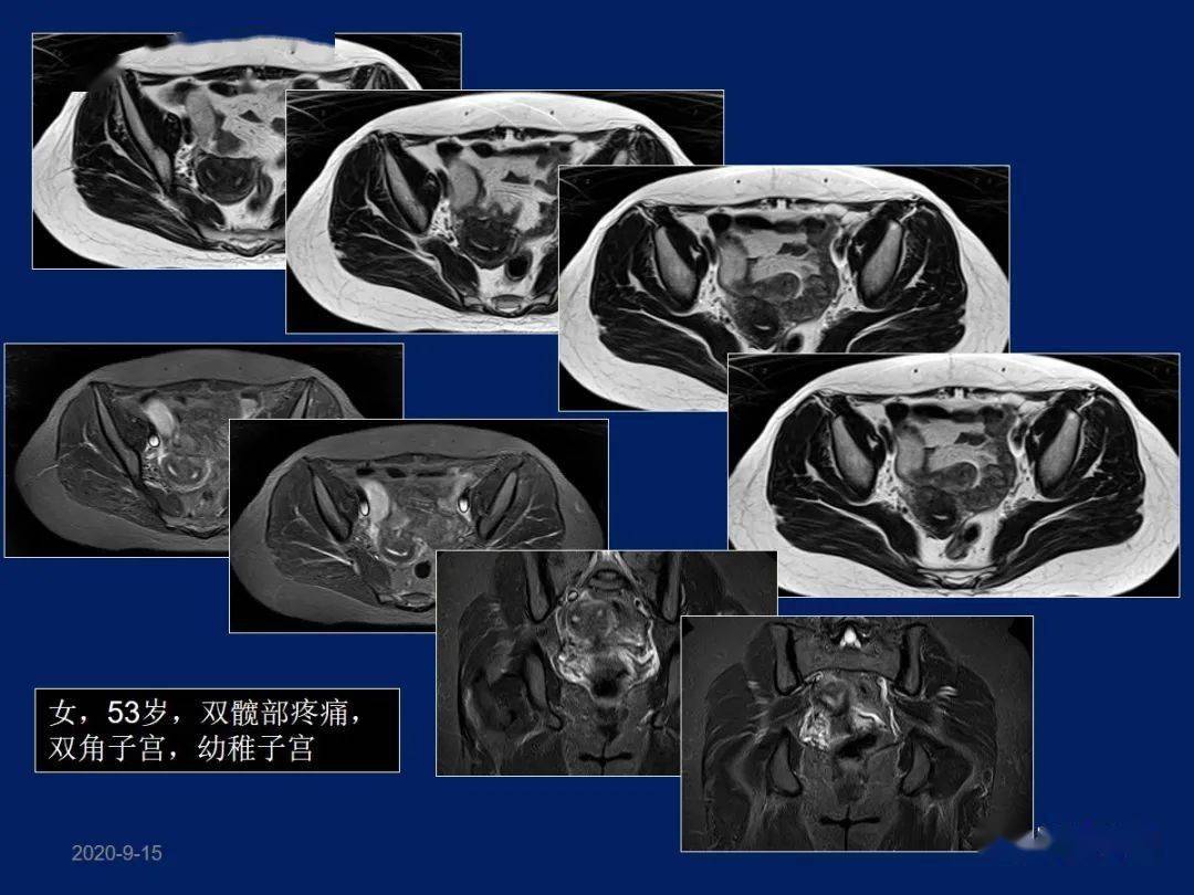妇产科常见疾病MRI表现_子宫