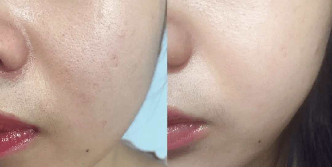 日本|日本人用酒洗脸，60岁还没有皱纹，黑头粉刺全消失，整张脸白皙光滑，细腻弹润！