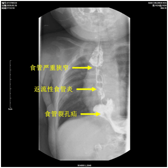 双镜|世界首例！我院完成双镜联合磁吻合技术微创治疗婴幼儿严重食管狭窄合并食管裂孔疝及返流性食管炎