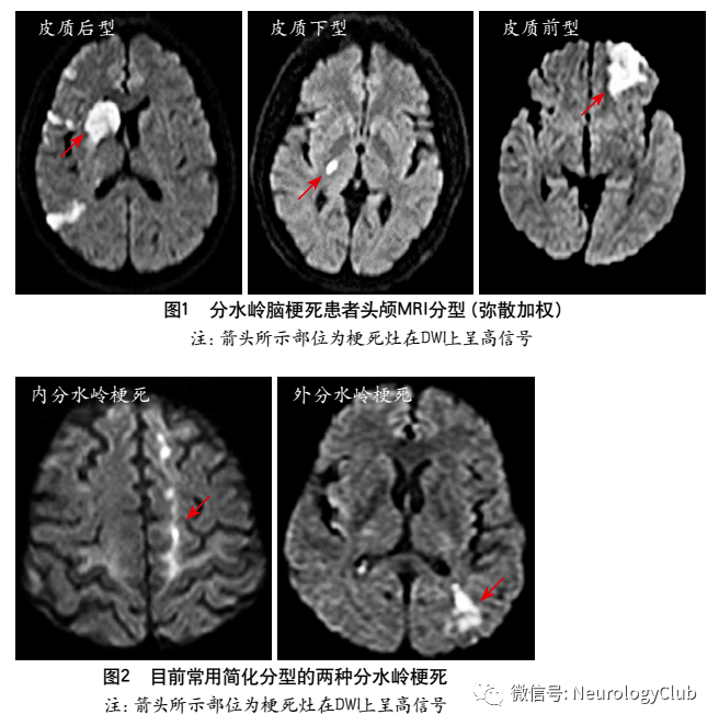 神经综述分水岭脑梗死的相关研究进展