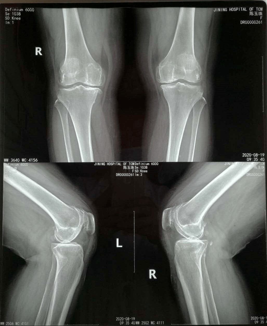 姐姐膝关节dr照片显示退行性变关节边缘骨质增生骨坠形成内侧间隙变窄