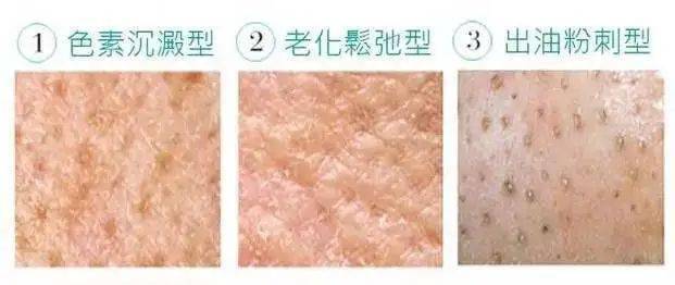 这些颗粒感有可能是老废角质堆积引在毛孔口起的毛周角化,或者角质