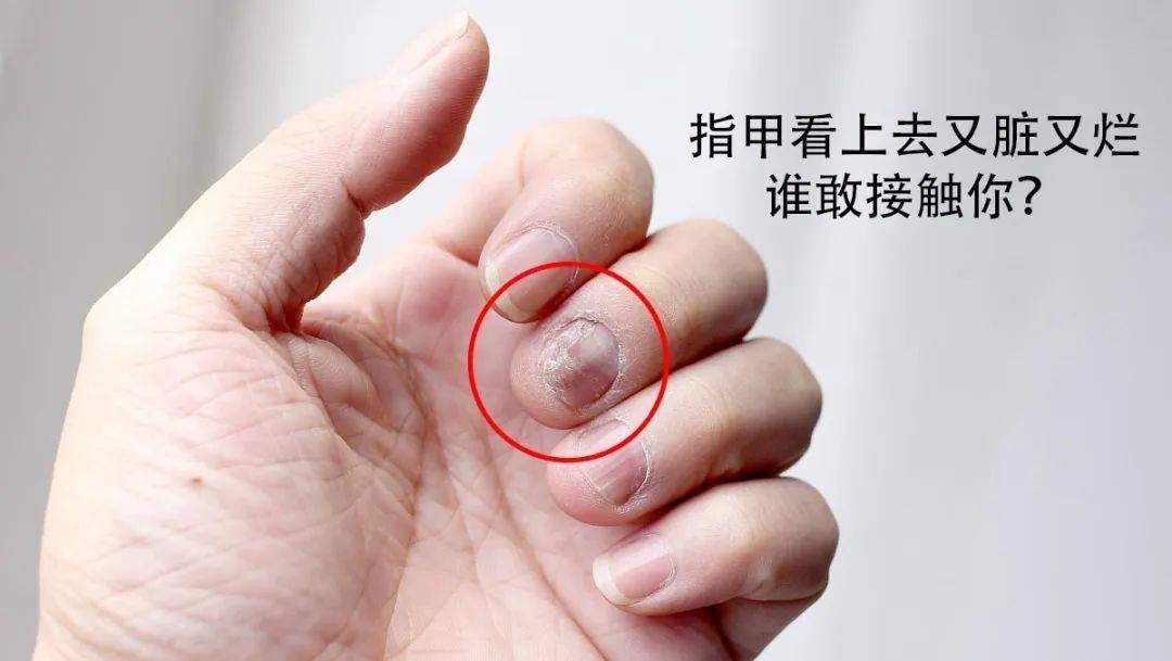 灰指甲为何难以恢复?这些误区现在知道还不晚