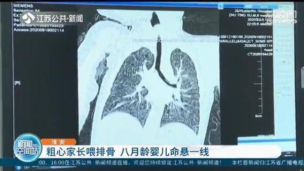 排骨|万不可大意！粗心家长喂排骨 八月龄婴儿命悬一线