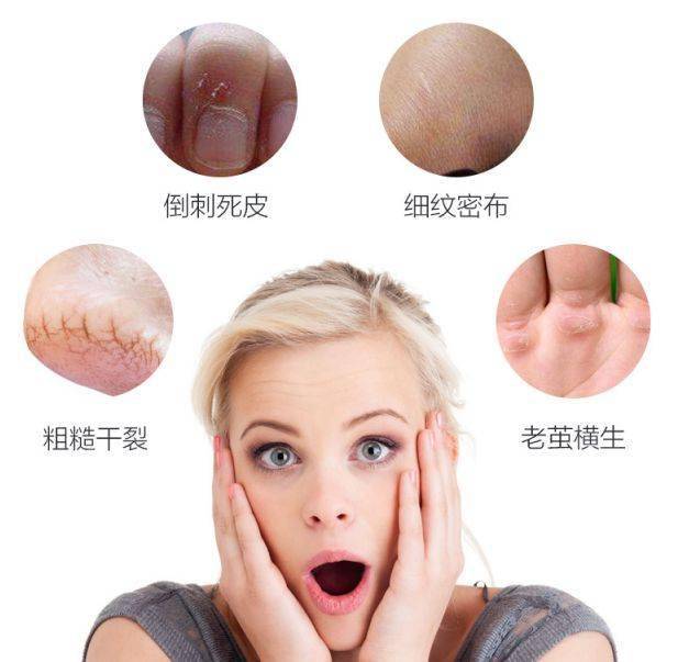 秋冬天气干，手、嘴唇还有四肢的皮肤，都是容易干裂的“重点保护区”，