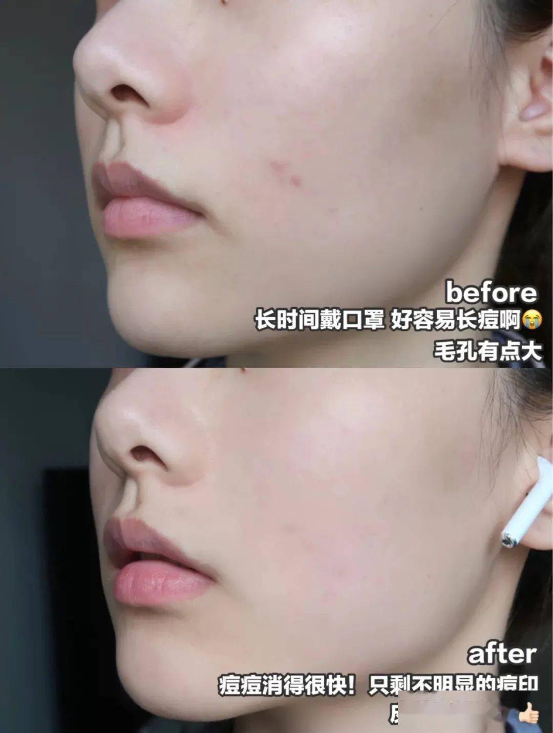 皮肤|刷酸=换脸？这个明星们超爱的百元刷酸好物搞定你的痘痘、闭口、黑头毛孔粗大还不怕烂脸！