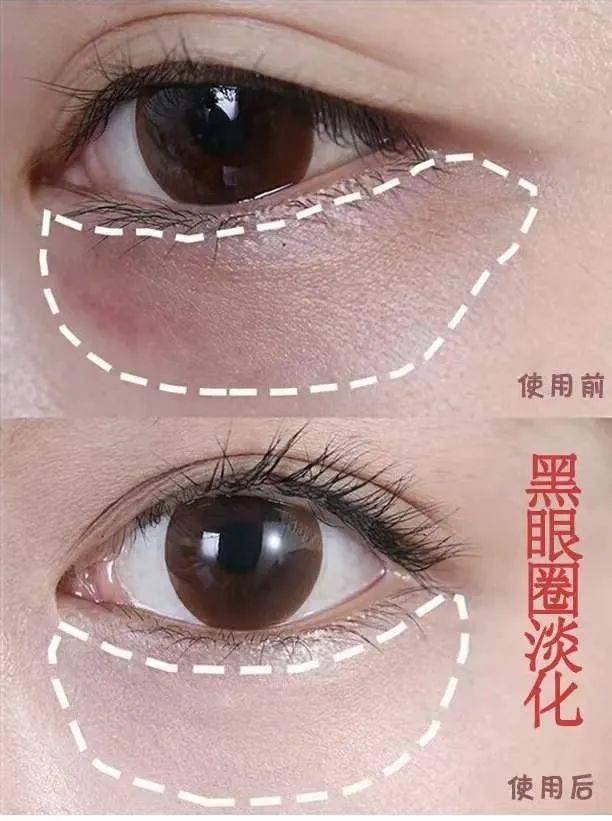 黑眼圈|马应龙新款眼霜买1送5，拼网速抢购中！早晚用一次，轻松缓解黑眼圈、浮肿眼袋、细纹皱纹，40岁阿姨也能抹出少女眼！