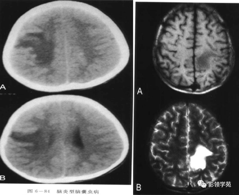 脑炎型见于囊虫感染之急性期. ct平扫表现为半球脑实质内低密度区.