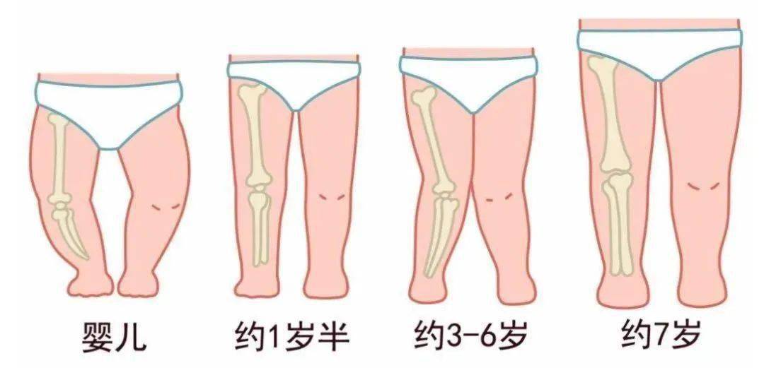 "x"状,这是正常的,到7,8岁左右,孩子腿又会变直,接近成人腿型的弯曲度