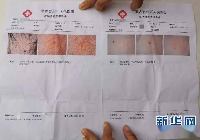 呼和浩特一幼儿园多名孩子身上现针眼，涉事三