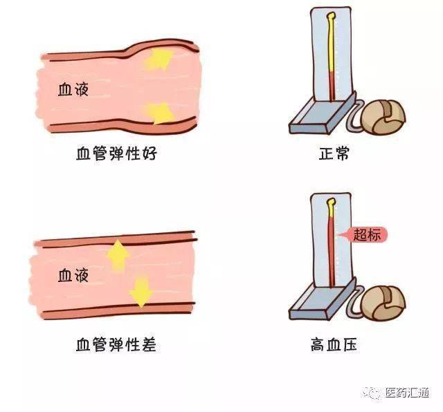 很多人得高血压却不知它是如何形成的一次说清高血压的来龙去脉