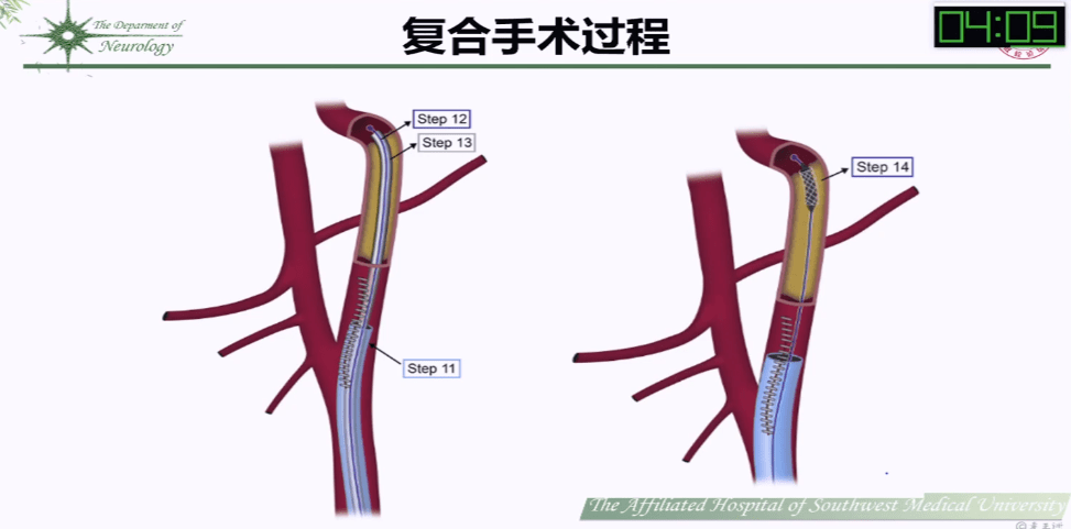 会议速览 | 神界大家说—颈动脉介入治疗那些事儿