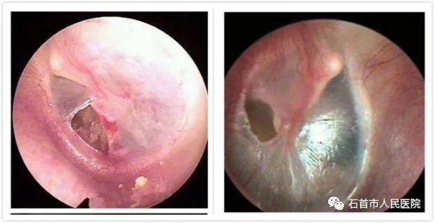 新技术市人民医院耳鼻喉科开展经耳内镜鼓膜修补及鼓室成形新技术
