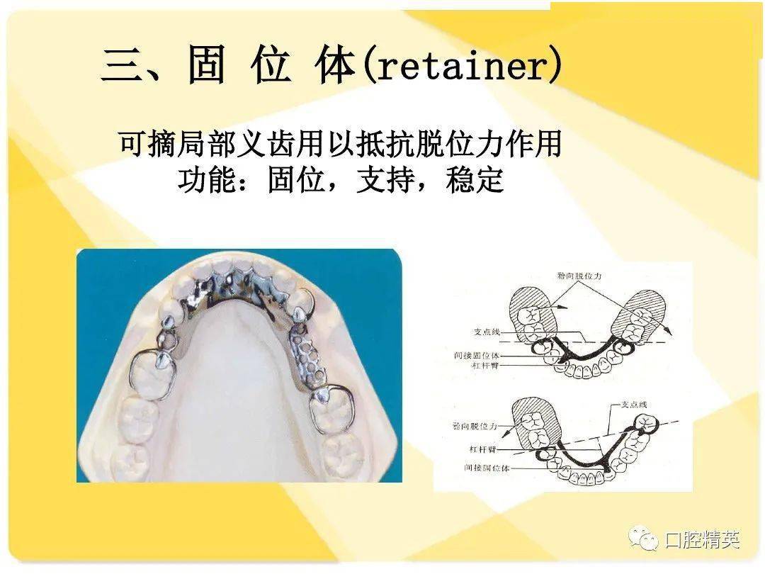 可摘局部义齿-结构