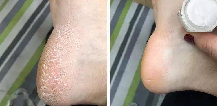 拖鞋|爱穿凉鞋、拖鞋出门的女人,脚上露出这个东西也太丑了吧~