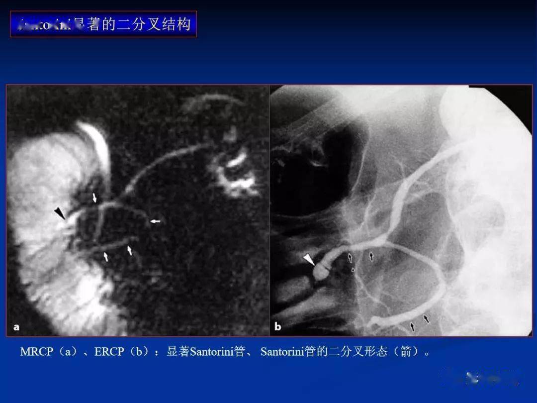 mrcp显示伴囊肿的背胰管(箭,腹胰管未显示.