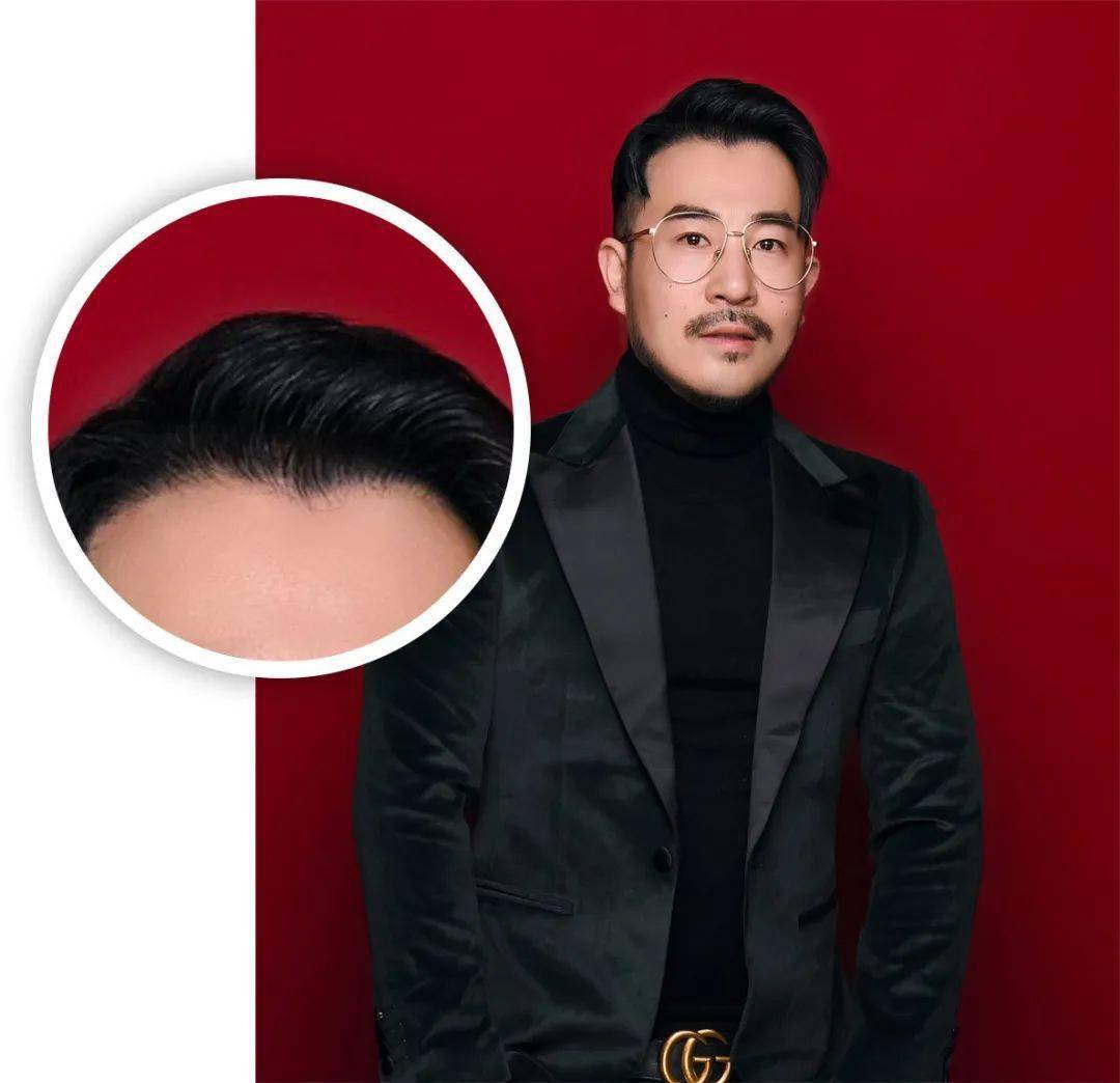 移植|国庆回去，我打算植发了！