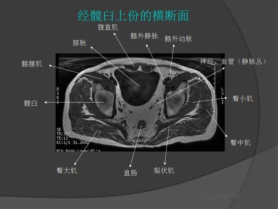 骨盆肌肉mri断层解剖_手机搜狐网