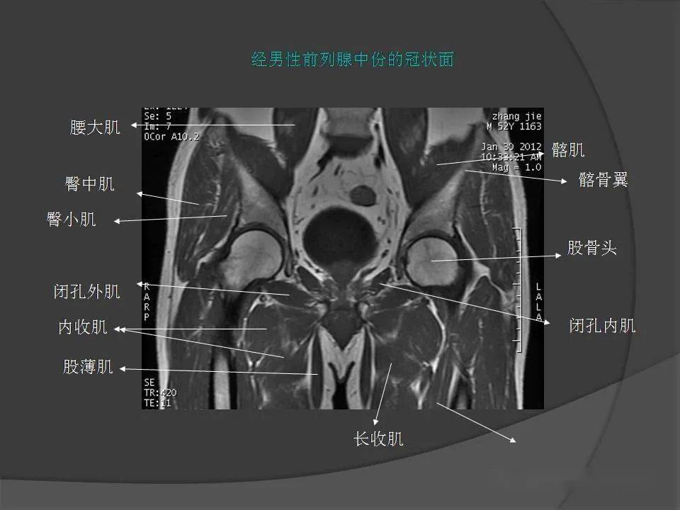 骨盆肌肉mri断层解剖