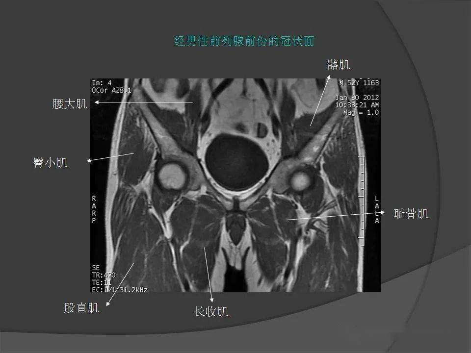 骨盆肌肉mri断层解剖