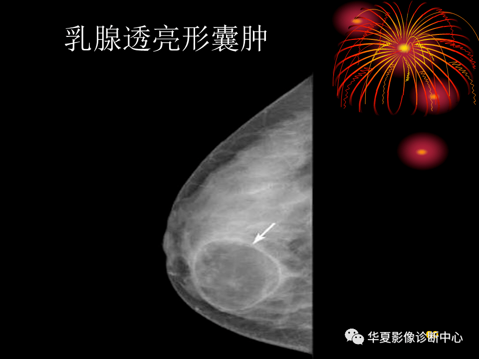 乳腺数字化钼靶x线诊断的临床应用