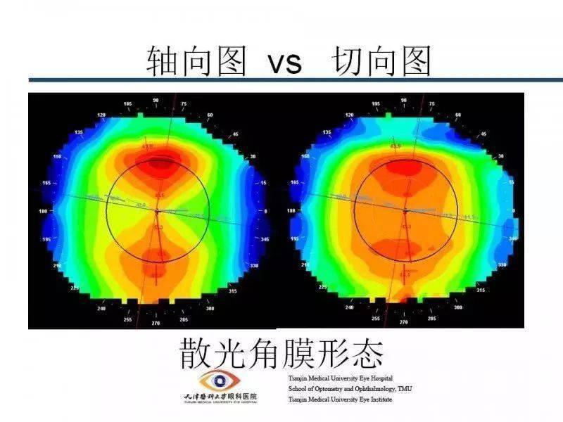 眼视光角膜地形图阅读及基本使用