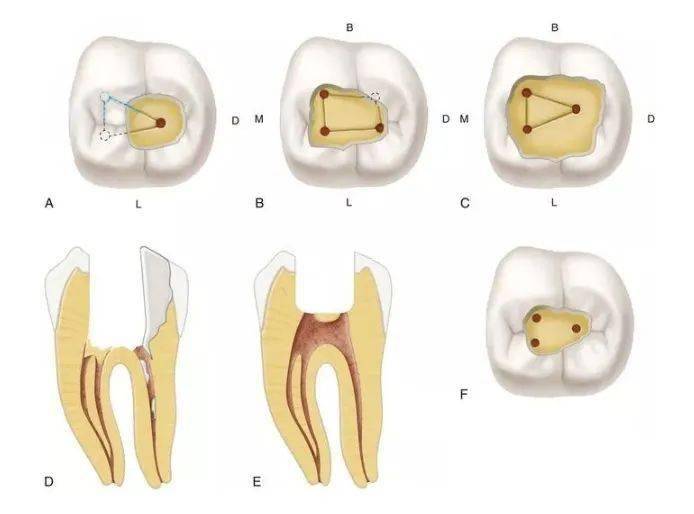 多根管牙若因某些原因,寻找根管口有困难时,除了应用牙齿髓腔解剖形态