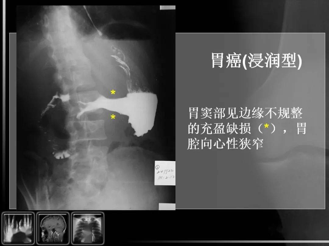 【汇总】消化道疾病影像诊断与鉴别_造影