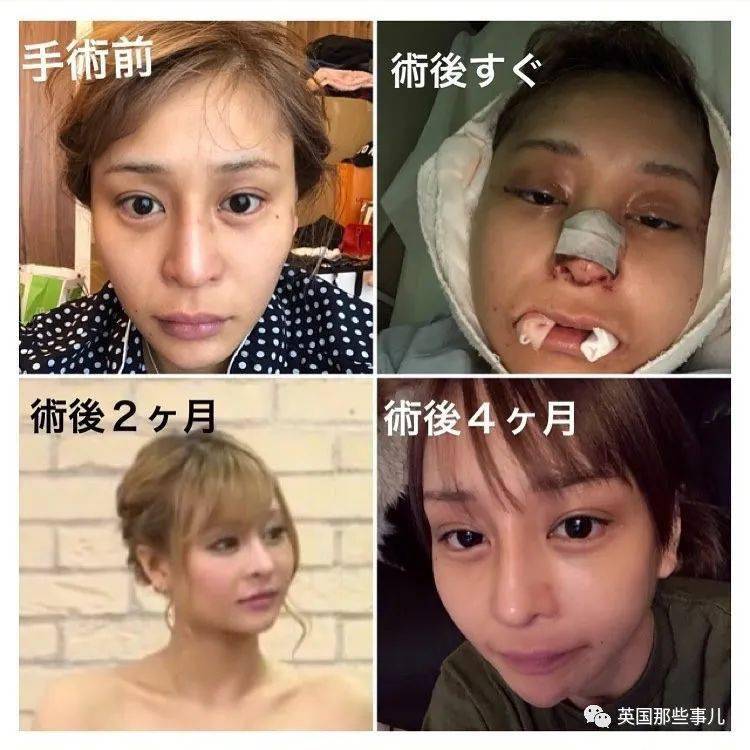 妹子|霓虹妹子整容上百次＂走上人生巅峰＂，以后还想整成桥本环奈…