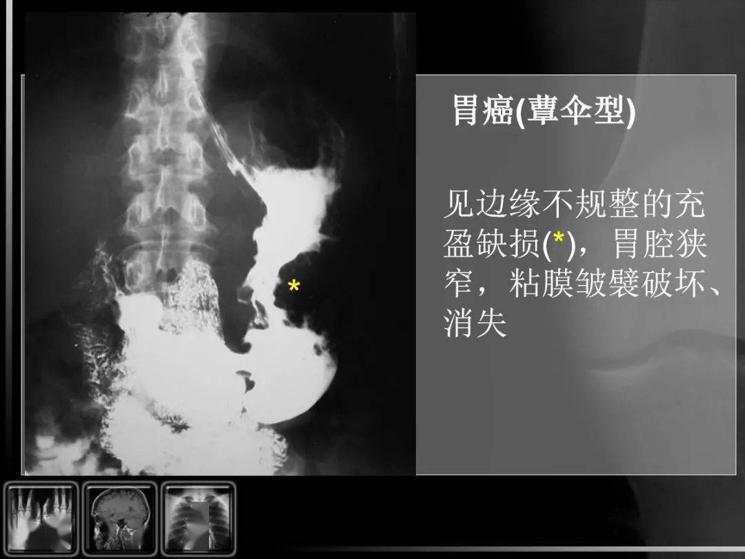 【汇总】消化道疾病影像诊断与鉴别_造影