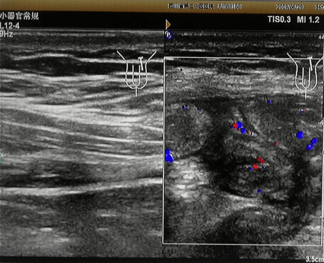腹股沟疝的超声图像