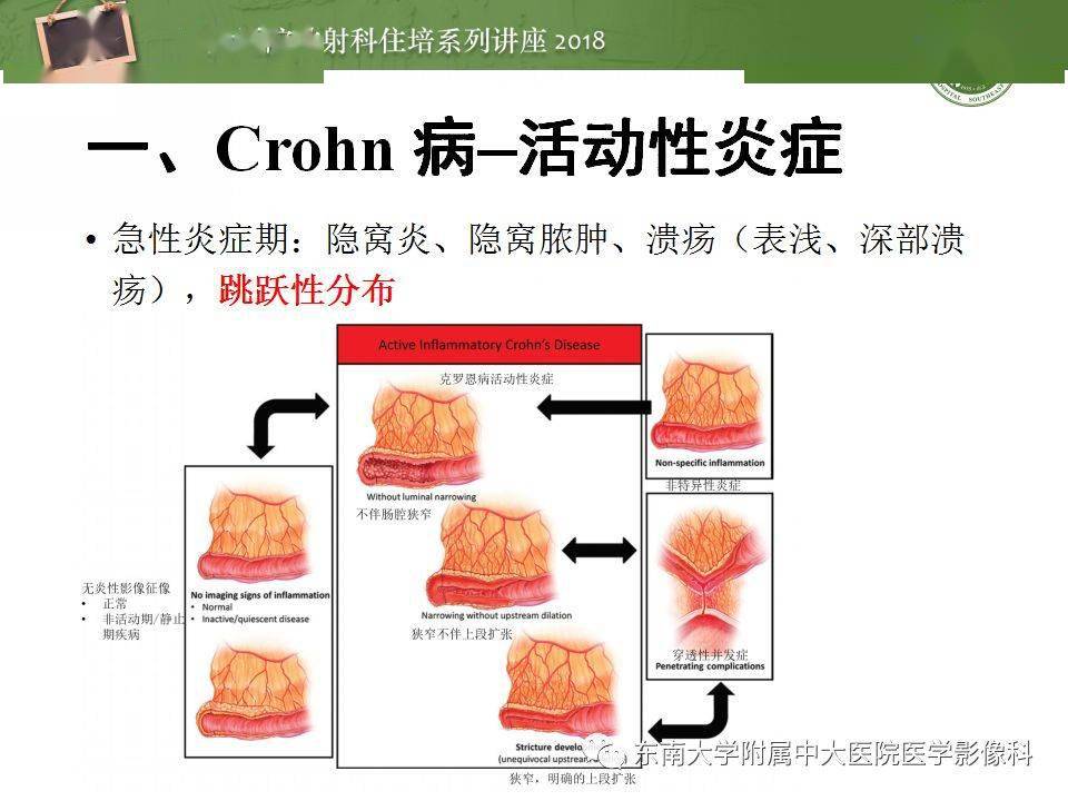 病理学:粘膜下固有层增厚伴慢性炎症细胞浸润,隐窝结构扭曲,隐窝炎