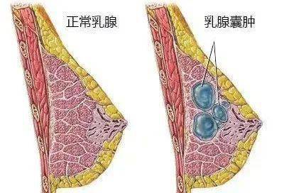 大医生来了 | "粉红丝带月":关爱女性,关注乳房健康