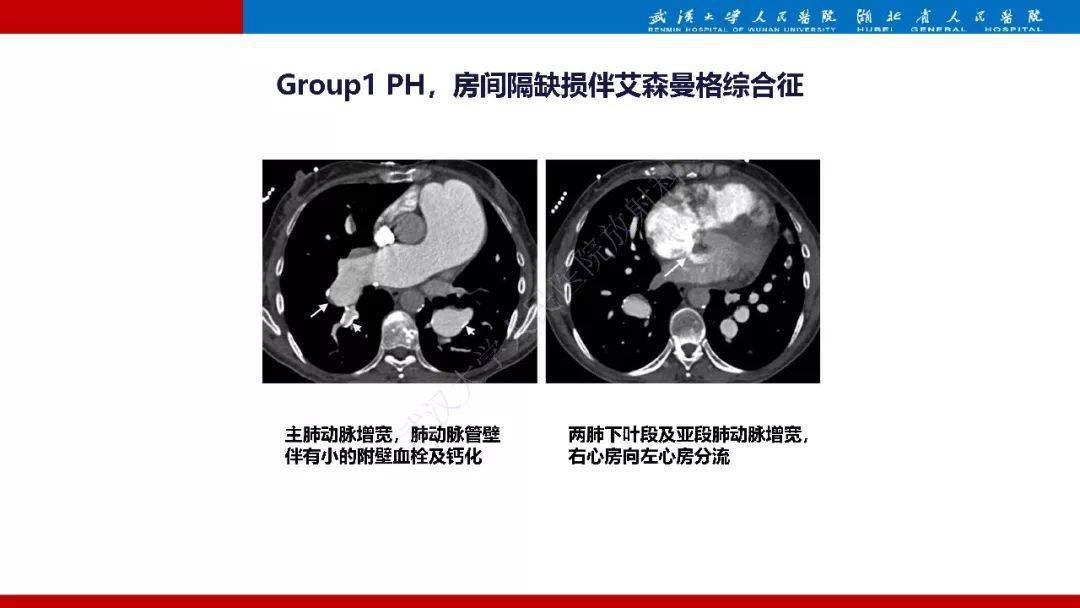 肺动脉高压临床分类及ct表现