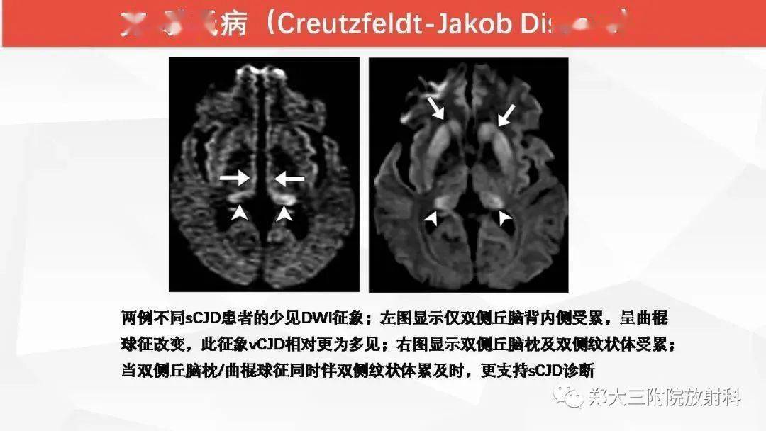 wernicke脑病的影像诊断