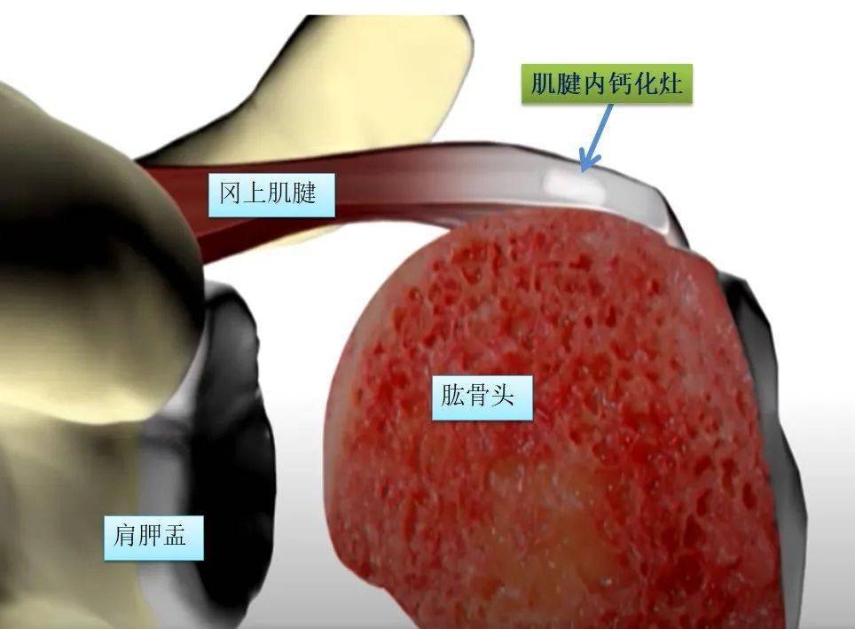 肌腱|援非日记 | 第292天，X光片解密急性发作的肩痛