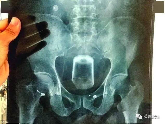 塞2斤金条藏8部手机…人类对肛门的探索太可怕了