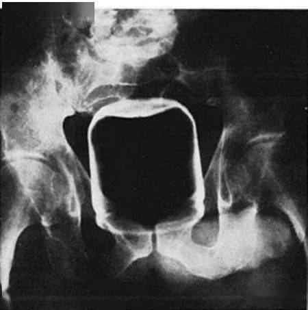 塞2斤金条藏8部手机…人类对肛门的探索太可怕了