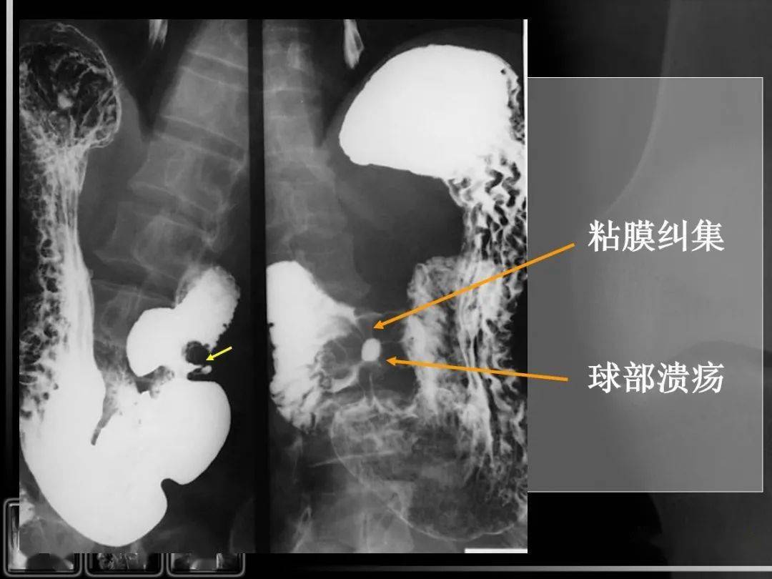 消化道疾病影像诊断与鉴别_造影
