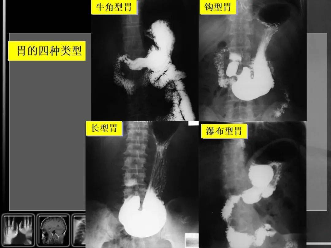 消化道疾病影像诊断与鉴别_造影