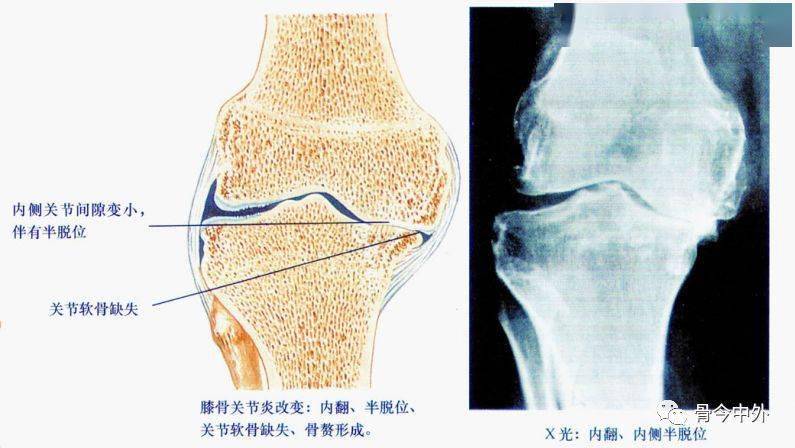 正常膝关节软骨