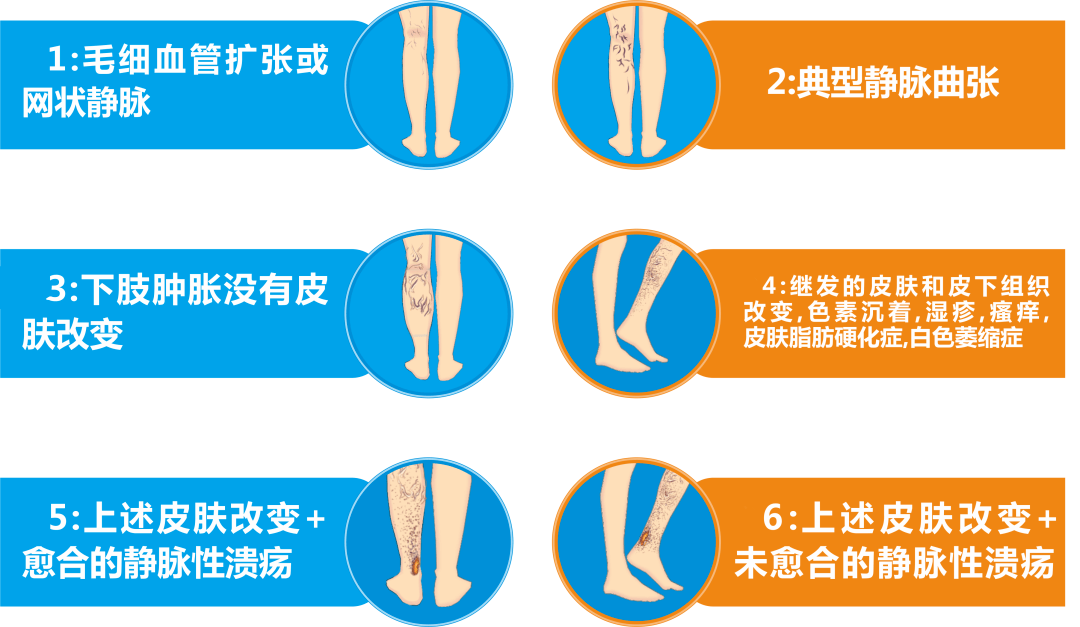 2020年贵州静脉曲张健康筛查援助已发放 仅限50名!速领_手机搜狐网